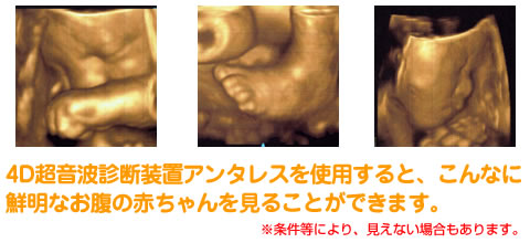 4D超音波診断装置アンタレスを使用すると、こんなに鮮明なお腹の赤ちゃんを見ることができます。※条件等により、見えない場合もあります。